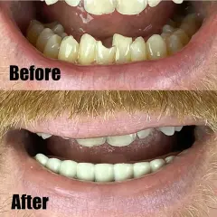 BOTTOM TEETH lower VENEER false Cosmetic secure smile