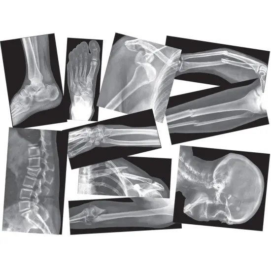 Broken Bones X-Ray Set, Pack of 15 {1}