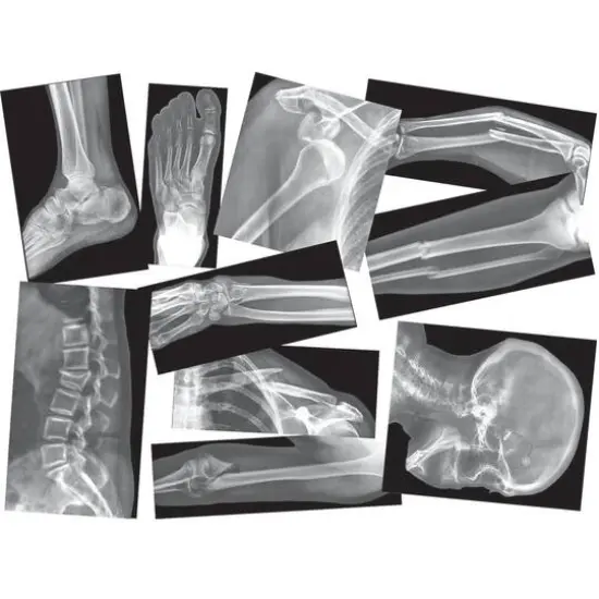Roylco&reg; Broken Bones X-Ray Set, Pack of 15 {1}